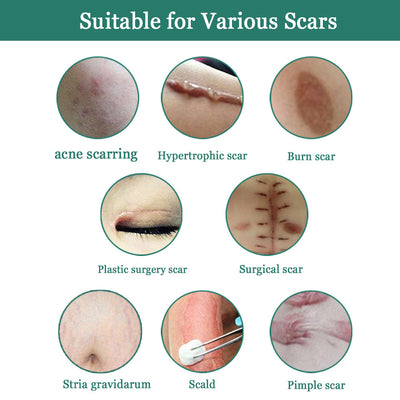 Skin Smoothing And Repairing Cream For Scalding And Burn Scars